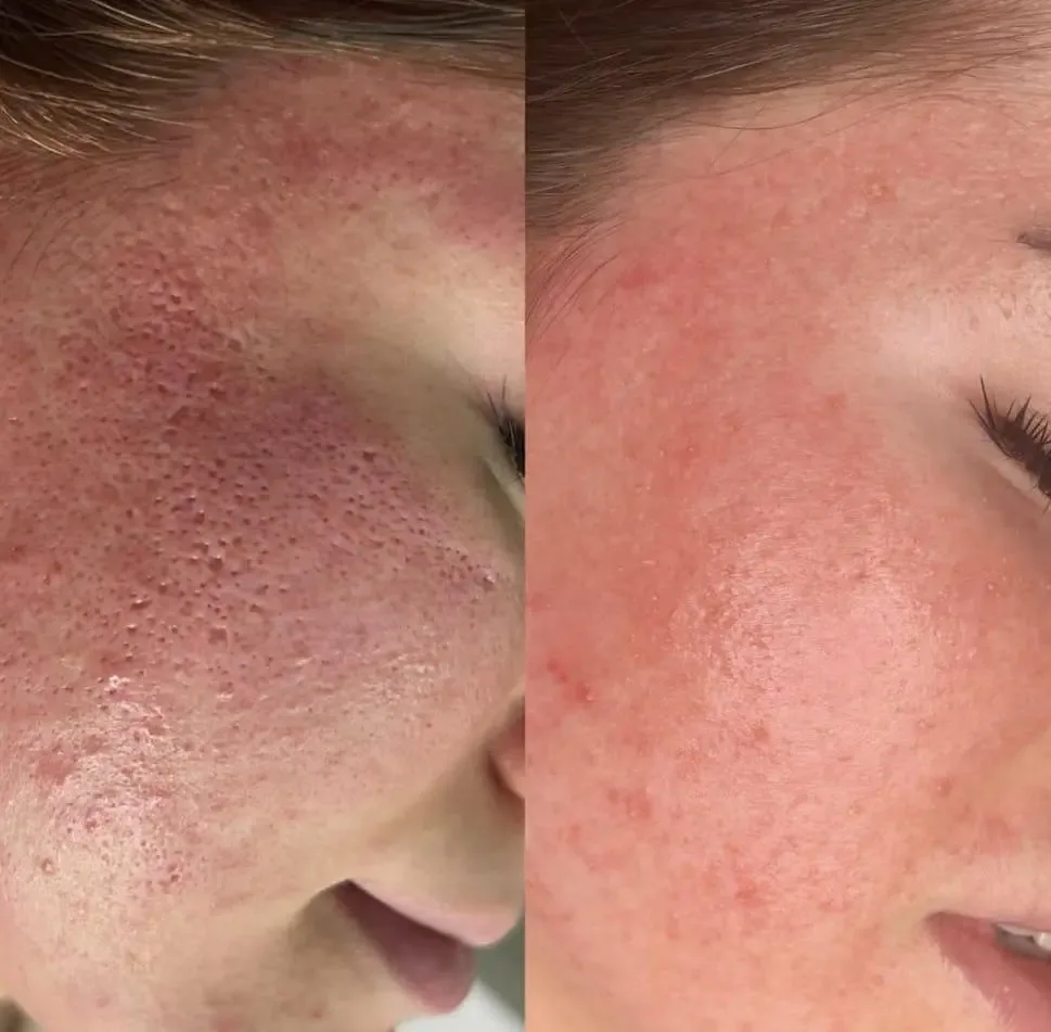 Antes e depois do tratamento de cicatriz no rosto