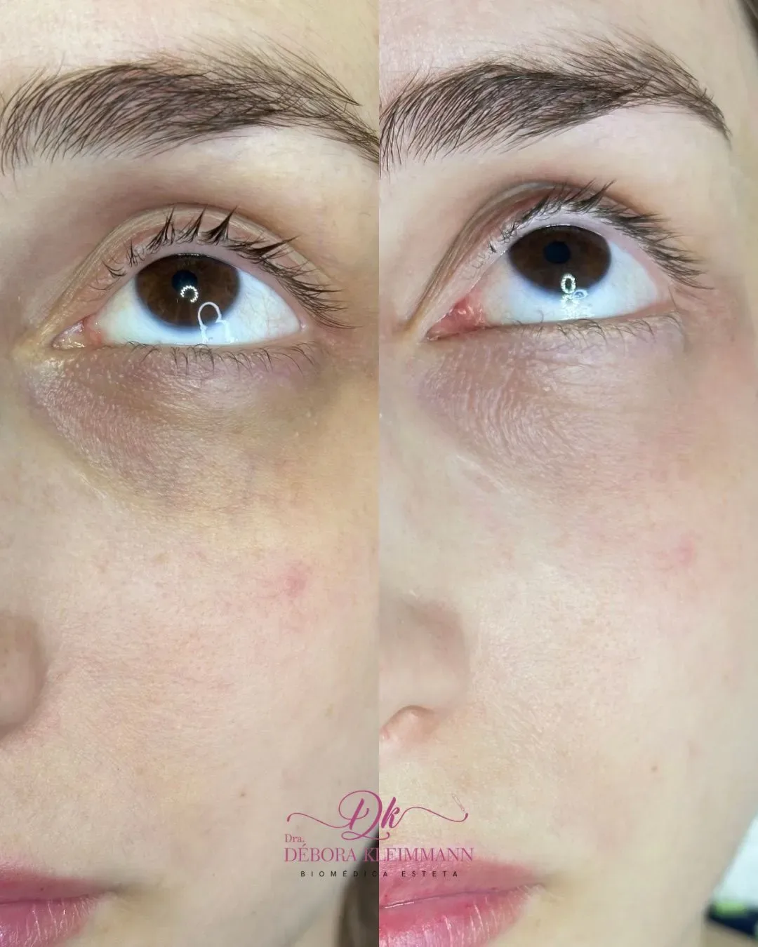 Resultado de camuflagem de olheiras realizada pela Dra. Débora Kleimmann