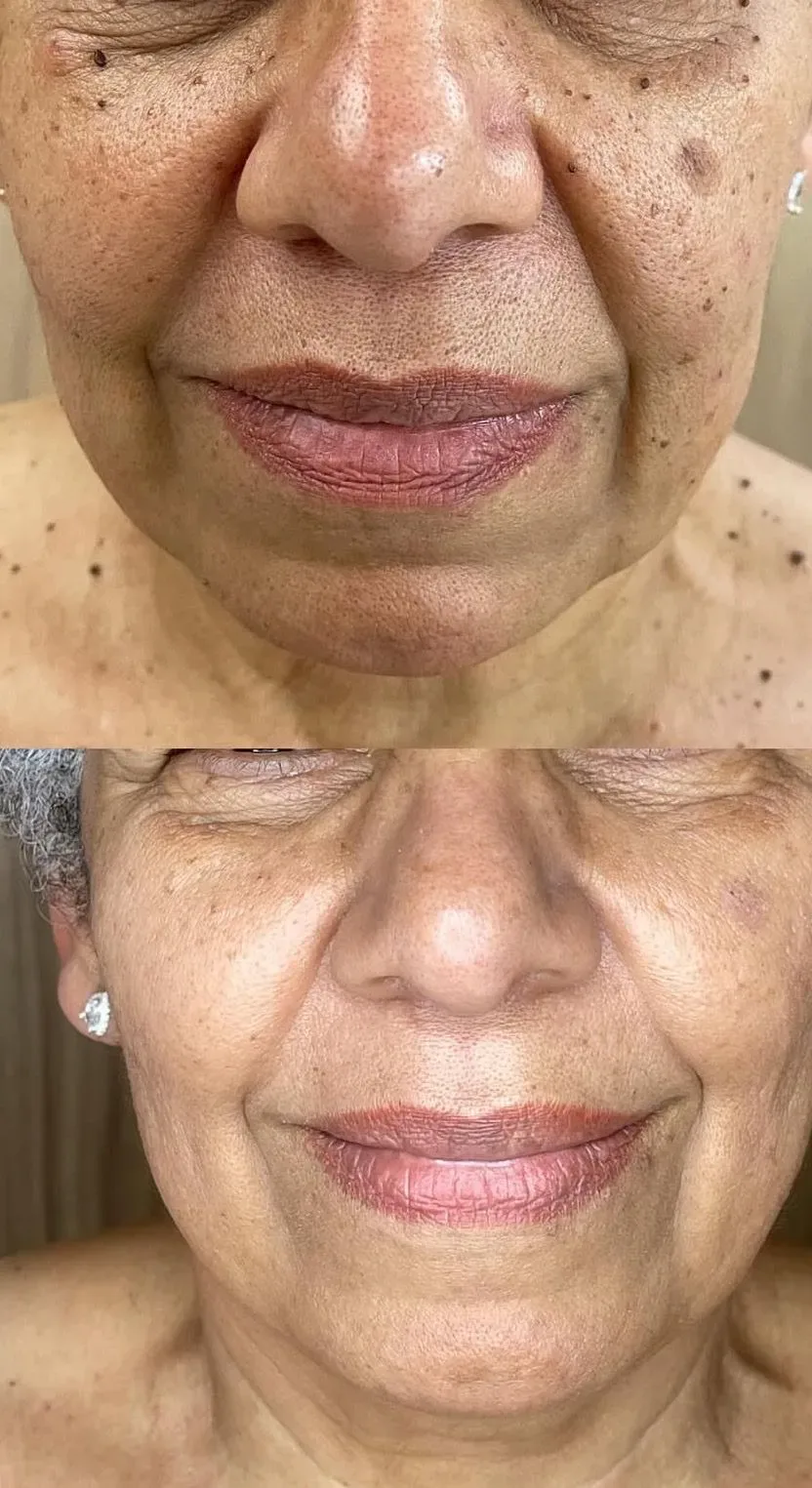 Antes e depois da remoção de verrugas